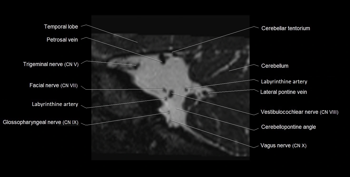Internal auditory meatus (IAM) 3T sagittal cross sectional anatomy image 31.webp